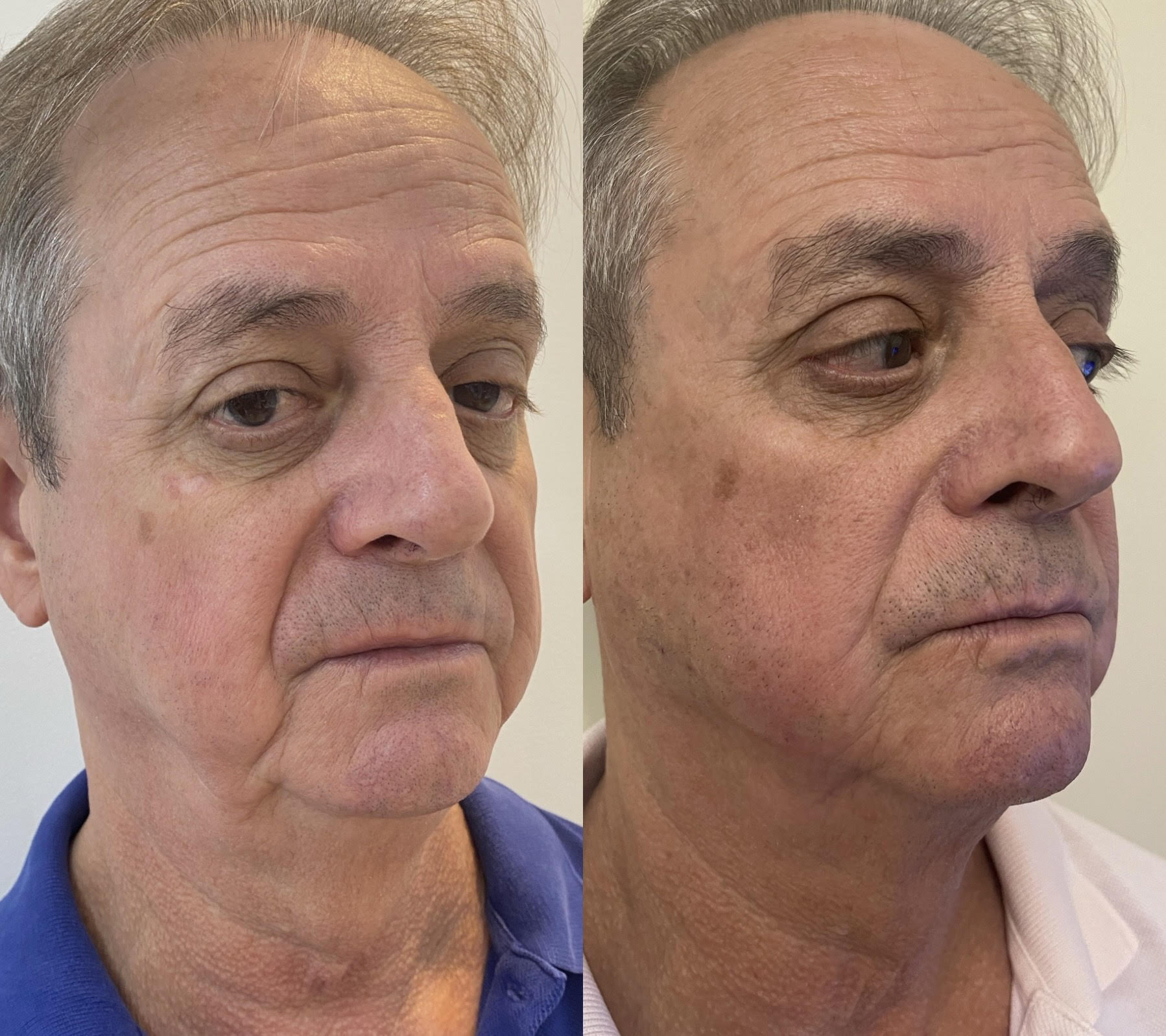 Resultado 2 de Bioestimuladores de Colágeno